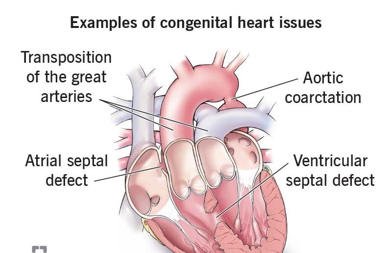 You are currently viewing ChildLife Foundation organised Webinar on “Approach to Congenital Heart Diseases in Children”     